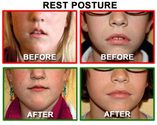 Mewing Teeth clenching, Facial muscles, Myofunctional therapy